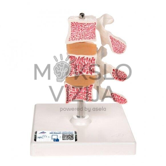 Žmogaus osteoporozės modelis