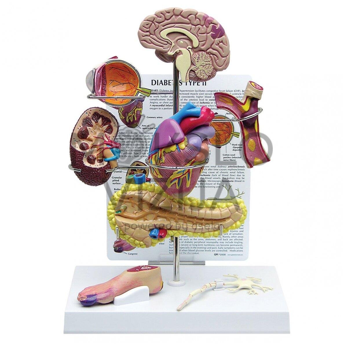 II tipo diabeto demonstracinis rinkinys