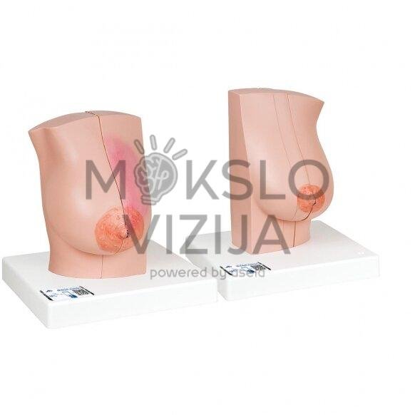 Moteriškos krūties su sveikais ir nesveikais audiniais modelis