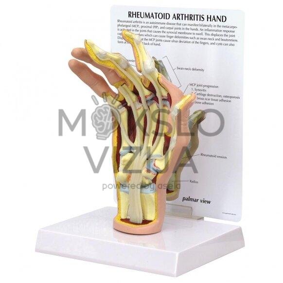 Reumatoidinio artrito modelis - ranka