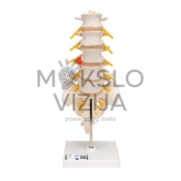 Žmogaus juosmens stuburinės dalies modelis su šoninio prolapso tarpslanteliniu disku